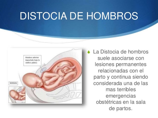 distocias de hombros